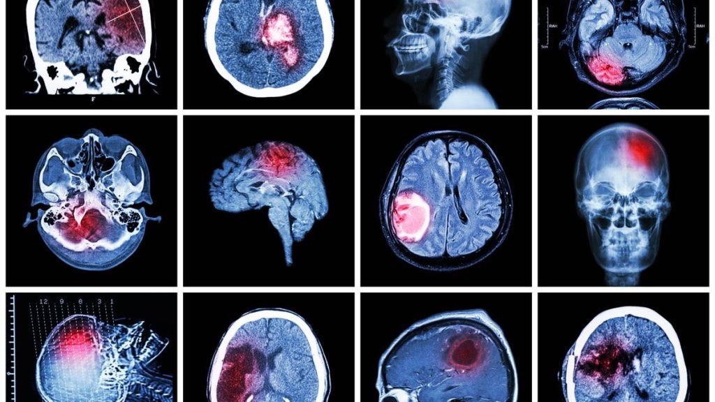 saiba-quais-sao-as-cinco-doencas-neurologicas-mais-comuns-em-idosos