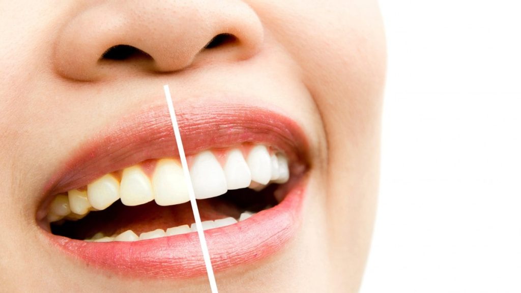 bleachorexia-ou-brancorexia: a-compulsao-por-clarear-os-dentes