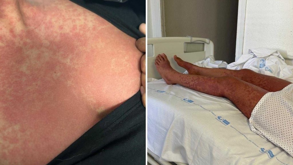 mulher-tem-alergia-grave-apos-ser-medicada-com-amoxicilina