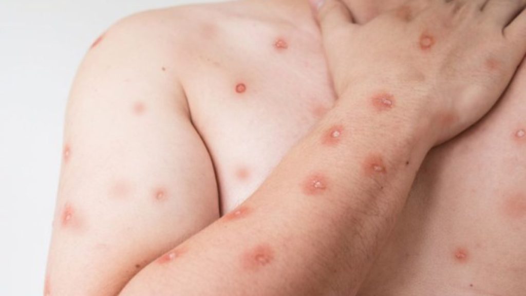 sao-paulo-registra-segundo-caso-da-nova-cepa-de-mpox-no-brasil
