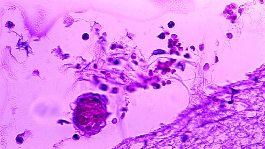 primeiros-meses-de-2026-tem-cerca-de-2-mil-casos-de-meningite